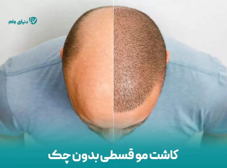 بهترین وام کاشت مو با سود مناسب از دنیای وام